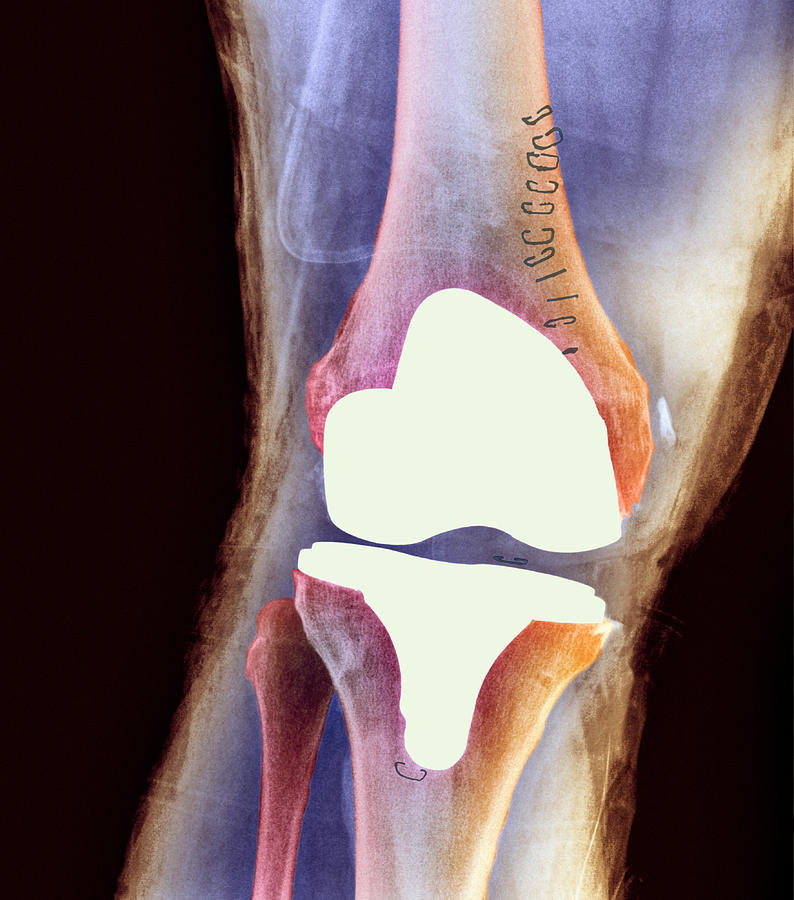 Knee Joint Replacement Photograph - Knee Joint Prosthesis, X-ray #4 by 