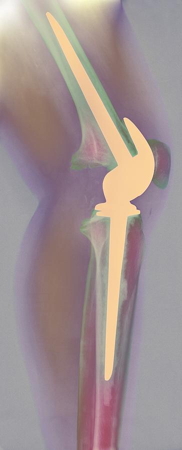 Knee Photograph - Knee Replacement, X-ray #4 by 