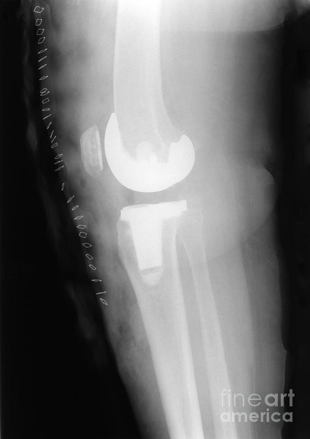 Xray Photograph - Knee Replacement X-ray #4 by Ted Kinsman