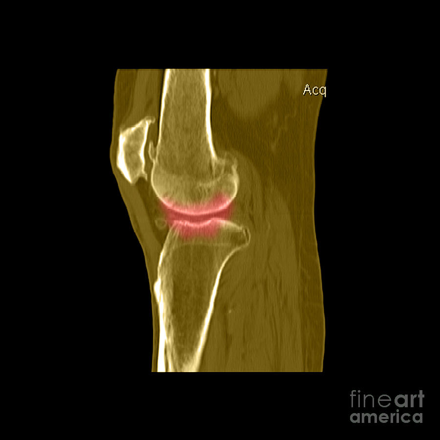 Knee Showing Osteoporosis #4 Photograph by Medical Body Scans