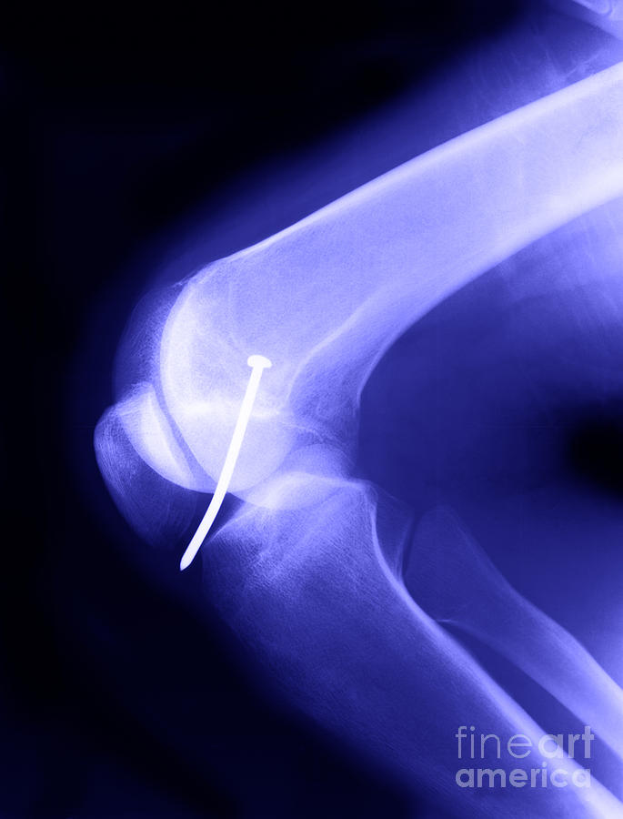 Knee X-ray #4 Photograph by Ted Kinsman