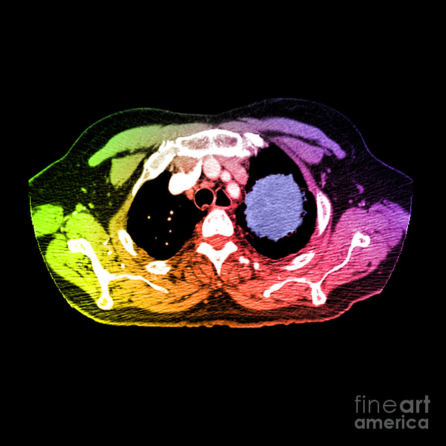 Spiral Ct Chest Photograph - Lung Cancer #4 by Medical Body Scans