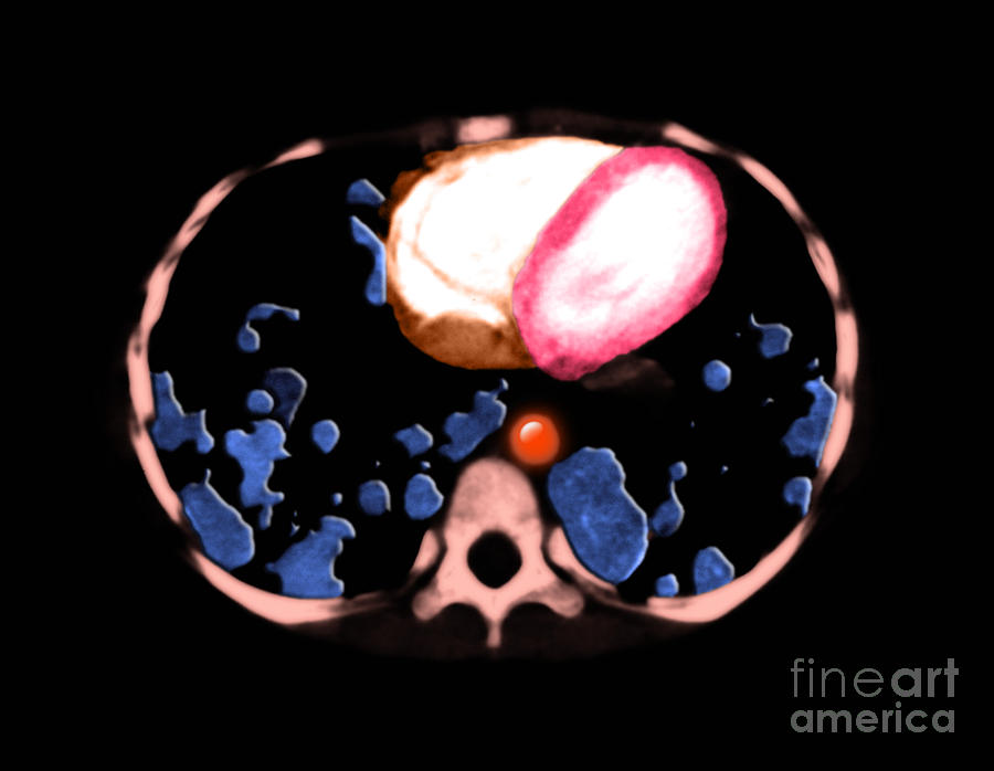 Ct Chest Photograph - Metastatic Disease Of The Lungs #4 by Medical Body Scans