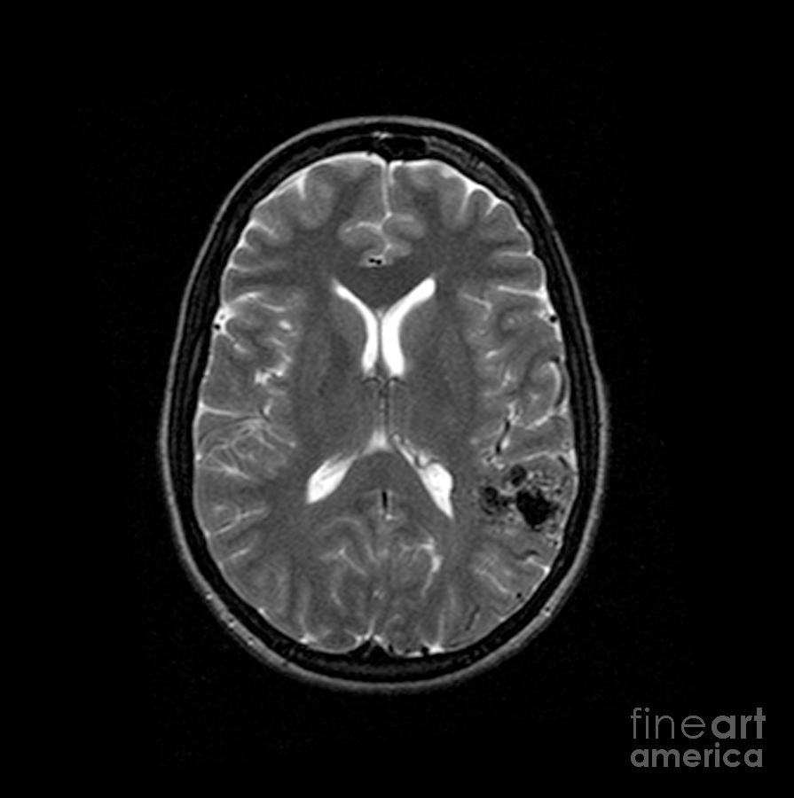 Mri Of Brain Avm #4 Photograph by Medical Body Scans