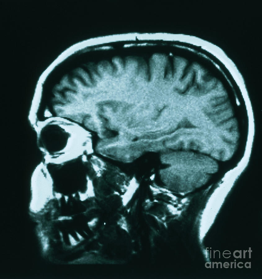 Mri Of Normal Brain #4 Photograph by Science Source