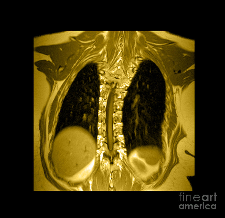 Mri Of Thoracic Scoliosis #4 Photograph by Medical Body Scans