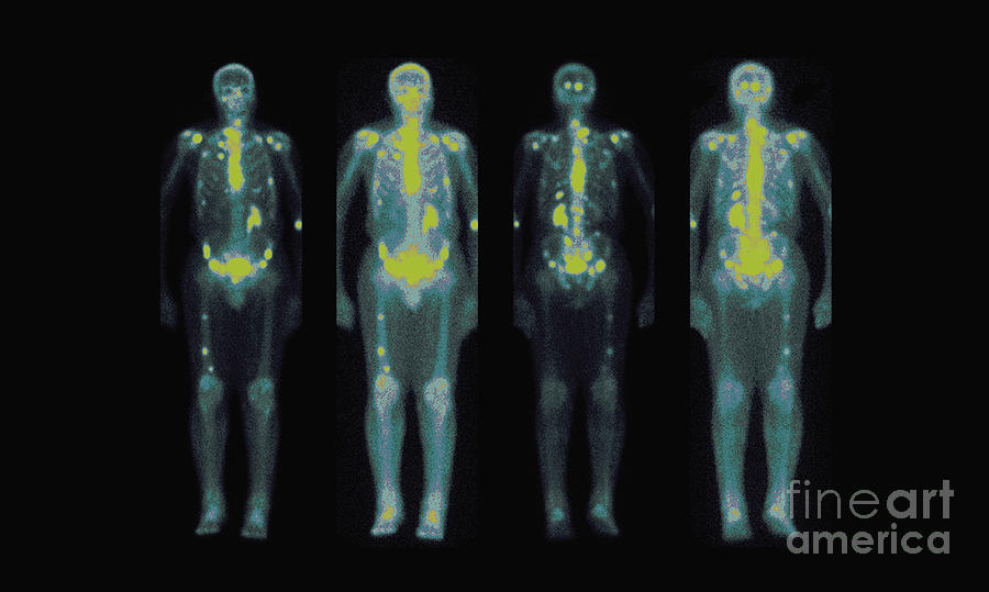 Nuclear Medicine Bone Scan #4 Photograph by Medical Body Scans
