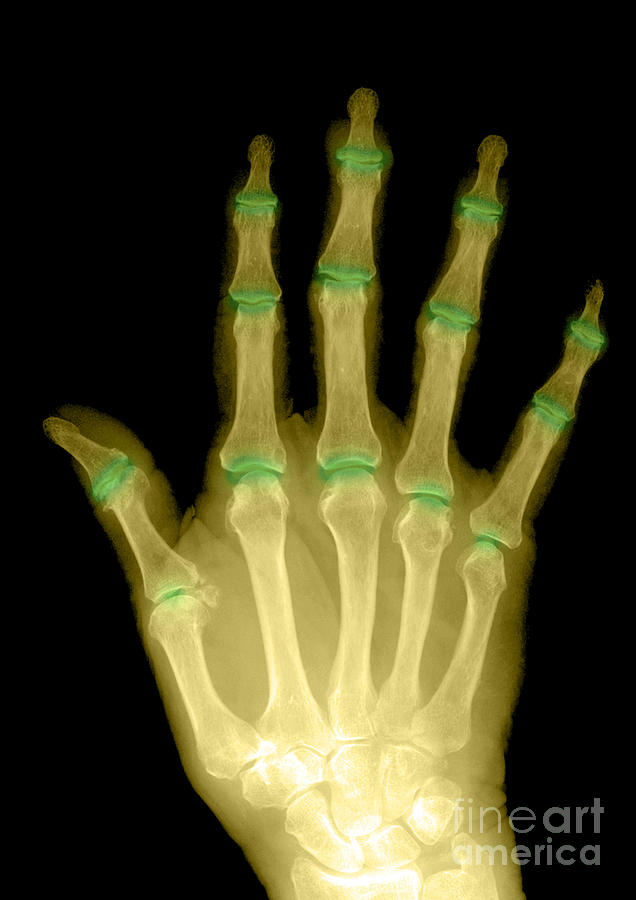 Osteoporosis And Degenerative Arthritis Photograph by Medical Body ...