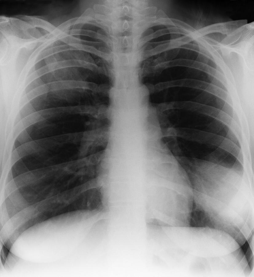 Pneumonia, X-ray Photograph by - Fine Art America