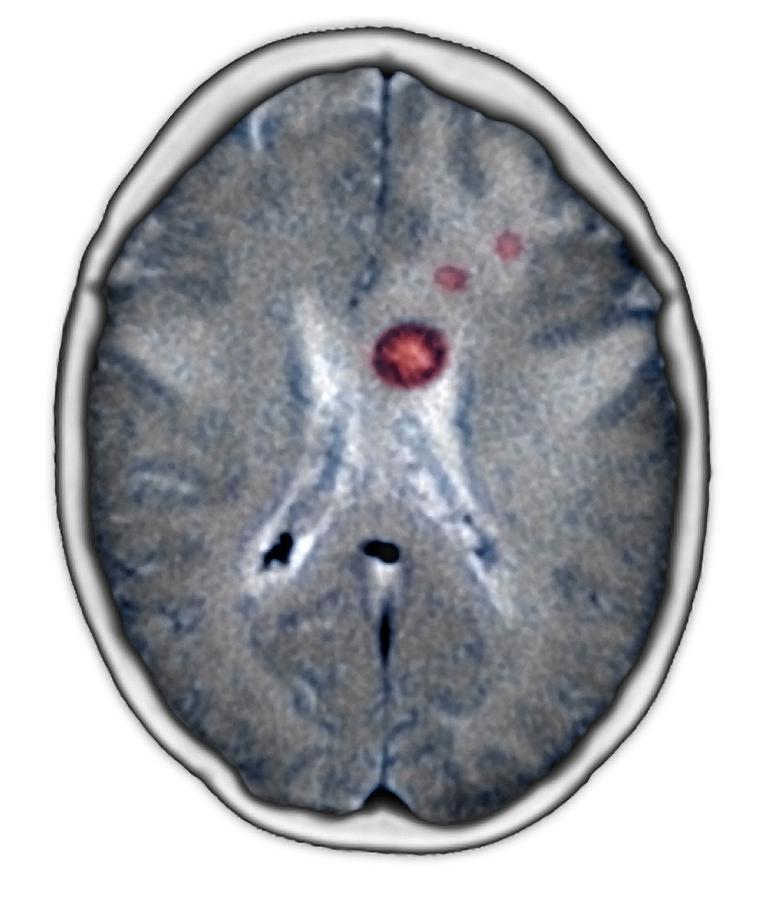 Medicine Photograph - Secondary Brain Cancers, Ct Scan #4 by Du Cane Medical Imaging Ltd