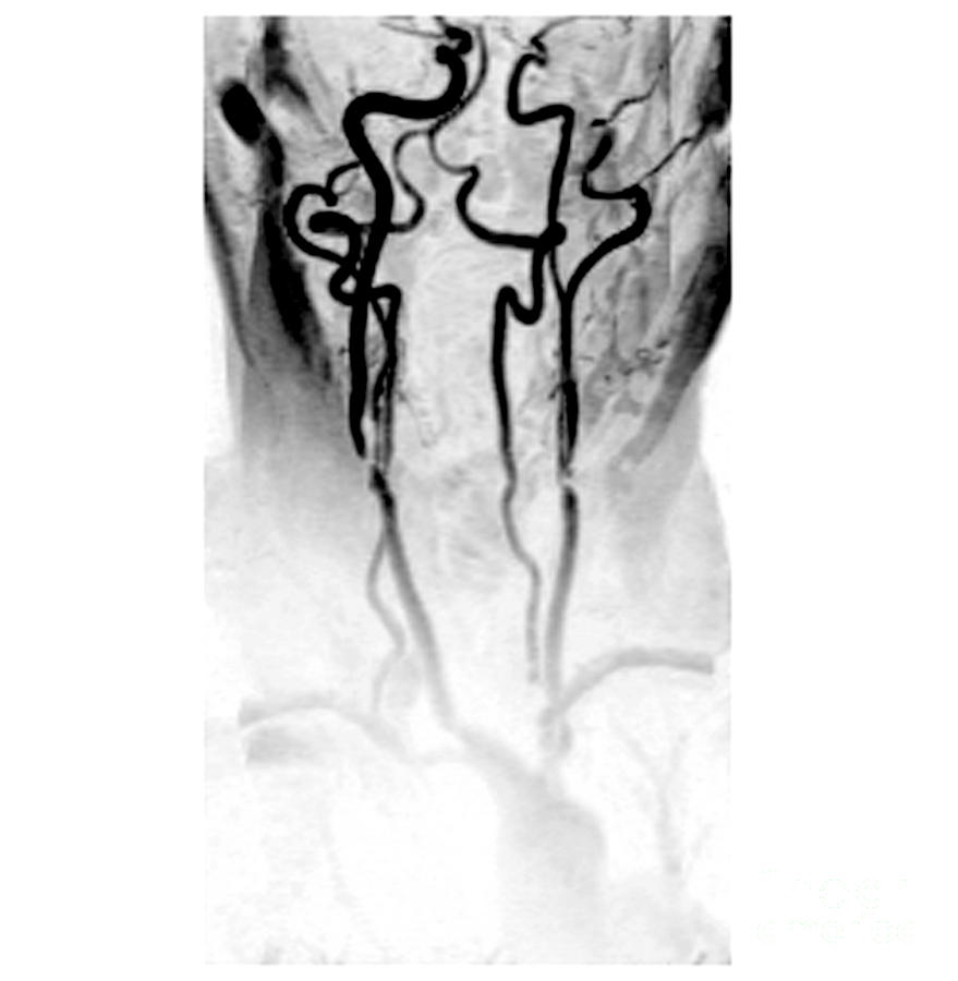 Stenosis Of The Internal Carotid #4 Photograph by Medical Body Scans