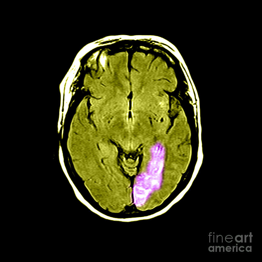 Stroke #4 Photograph by Medical Body Scans