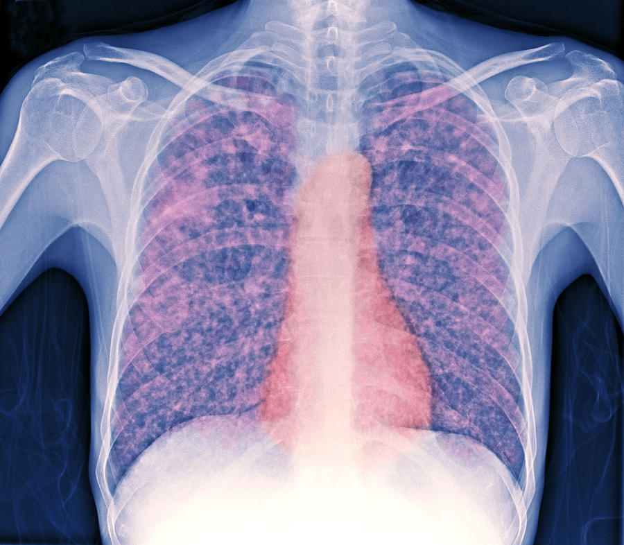 Tuberculosis X Ray Photograph By Du Cane Medical Imaging Ltd Fine Hot