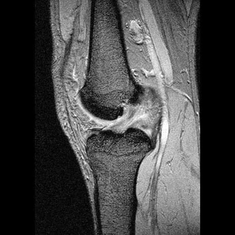 Anterior Cruciate Ligament Image