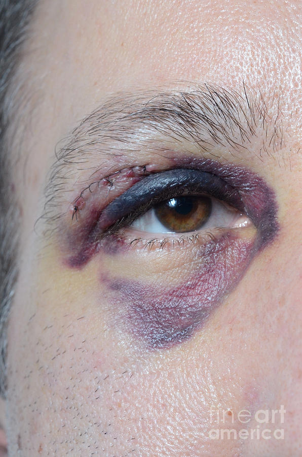 Adult Male Photograph - Black Eye #5 by Photo Researchers, Inc.