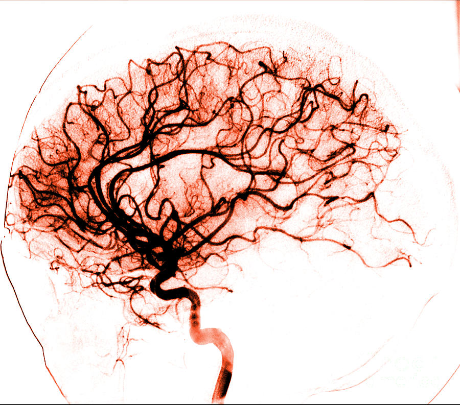 Cerebral Angiogram Photograph by Medical Body Scans