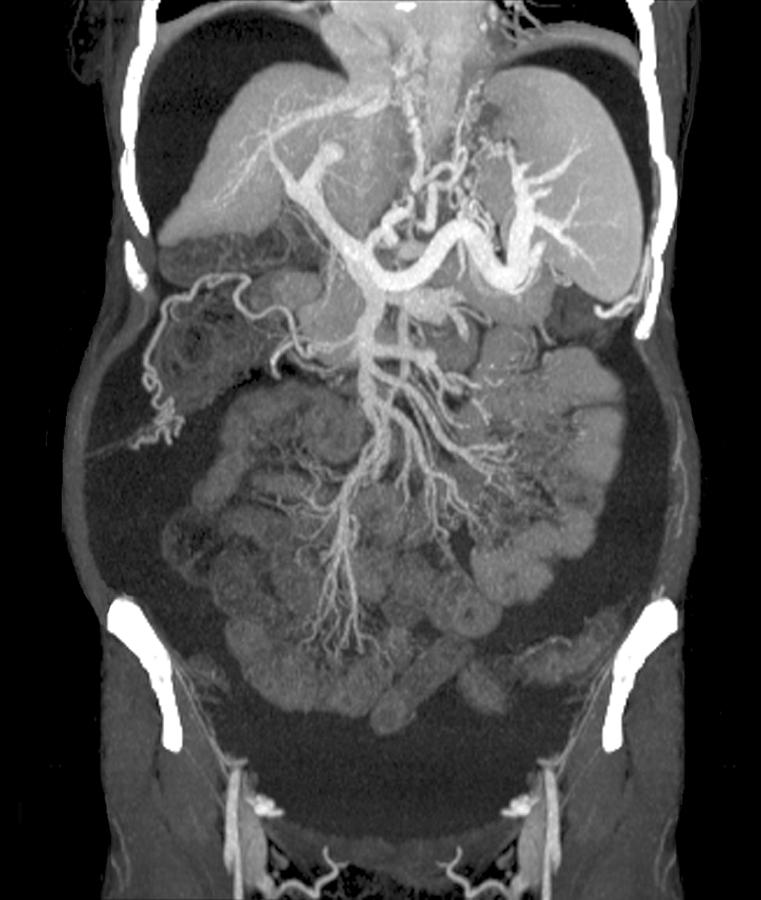 Black And White Photograph - Chronic Liver Disease, Ct Scan #5 by Zephyr