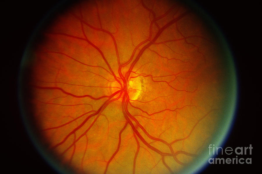Diabetic Retinopathy #5 Photograph by Science Source