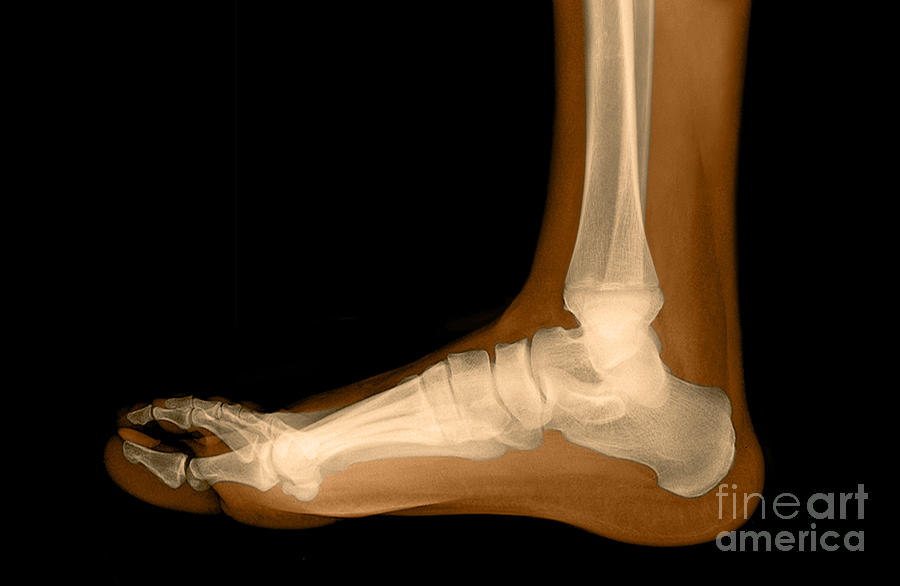 Flat Foot #5 Photograph by Medical Body Scans