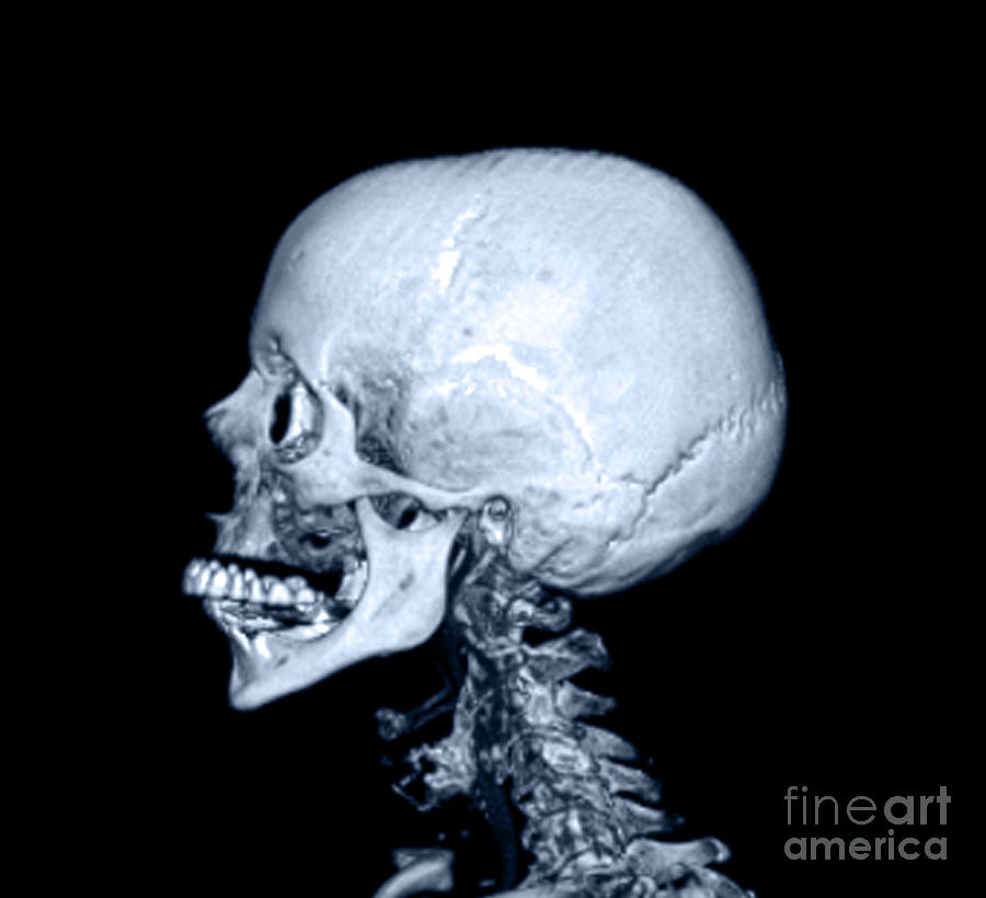 Skull Photograph - Human Skull #5 by Medical Body Scans