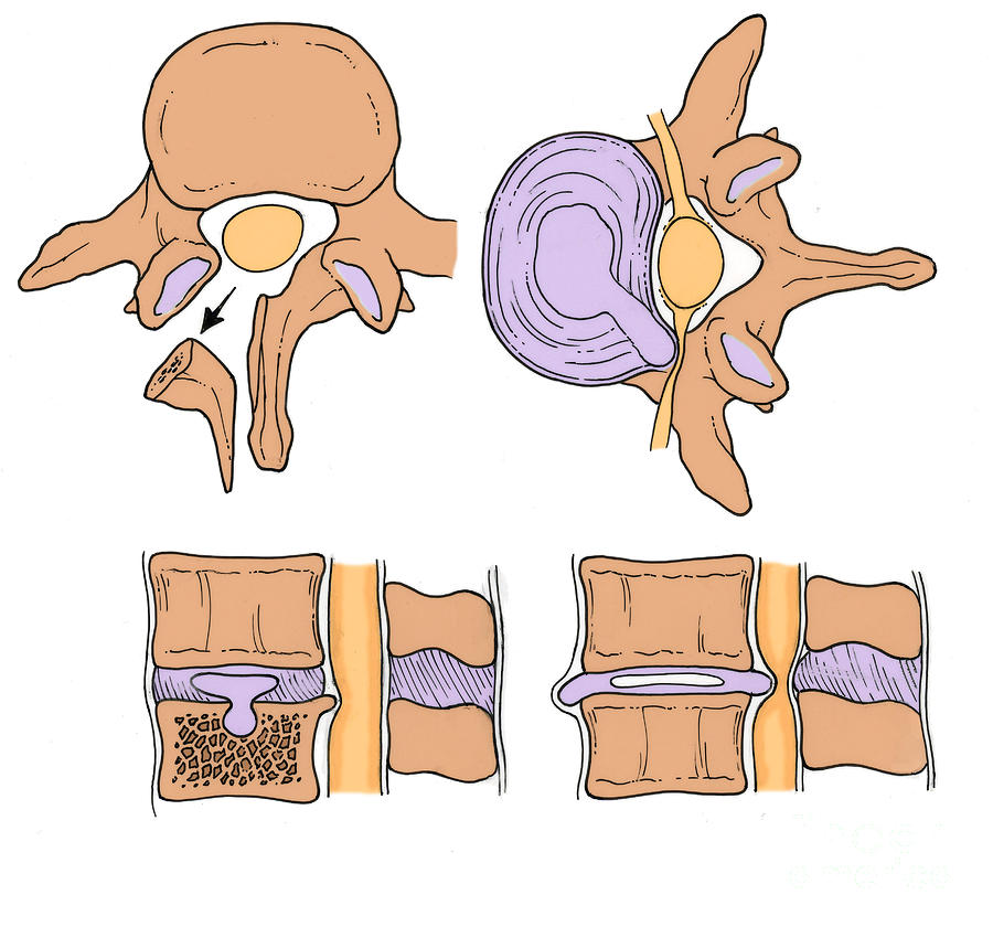Illustration Of Spinal Disk Pathologies #5 Photograph by Science Source