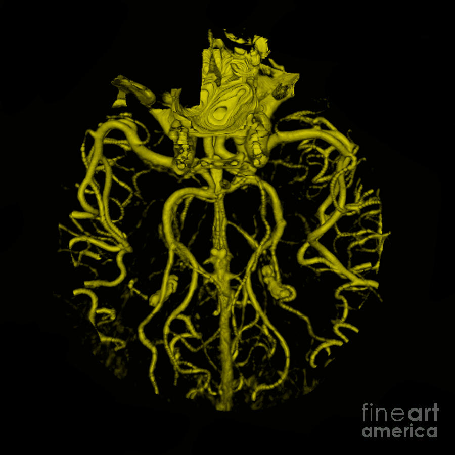 Intracranial Ct Angiogram #5 Photograph by Medical Body Scans