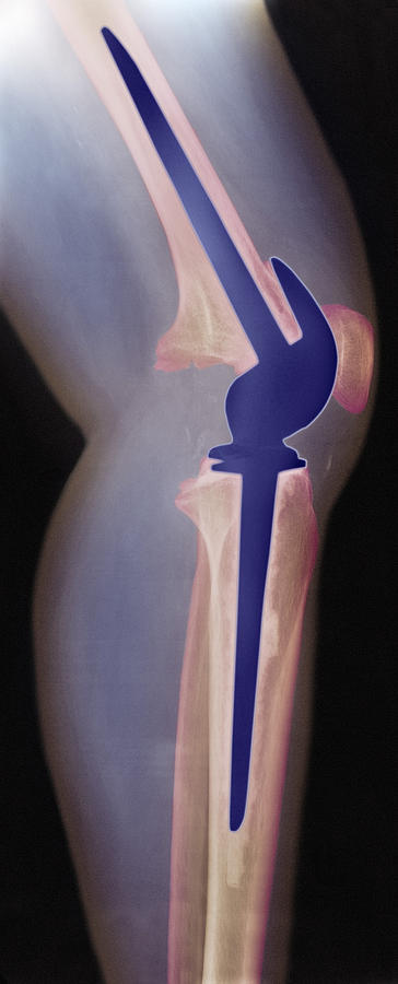 Knee Photograph - Knee Replacement, X-ray #5 by 