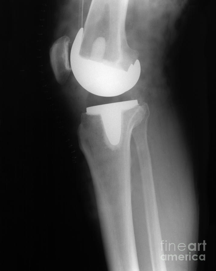 Knee Replacement X-ray Photograph by Ted Kinsman