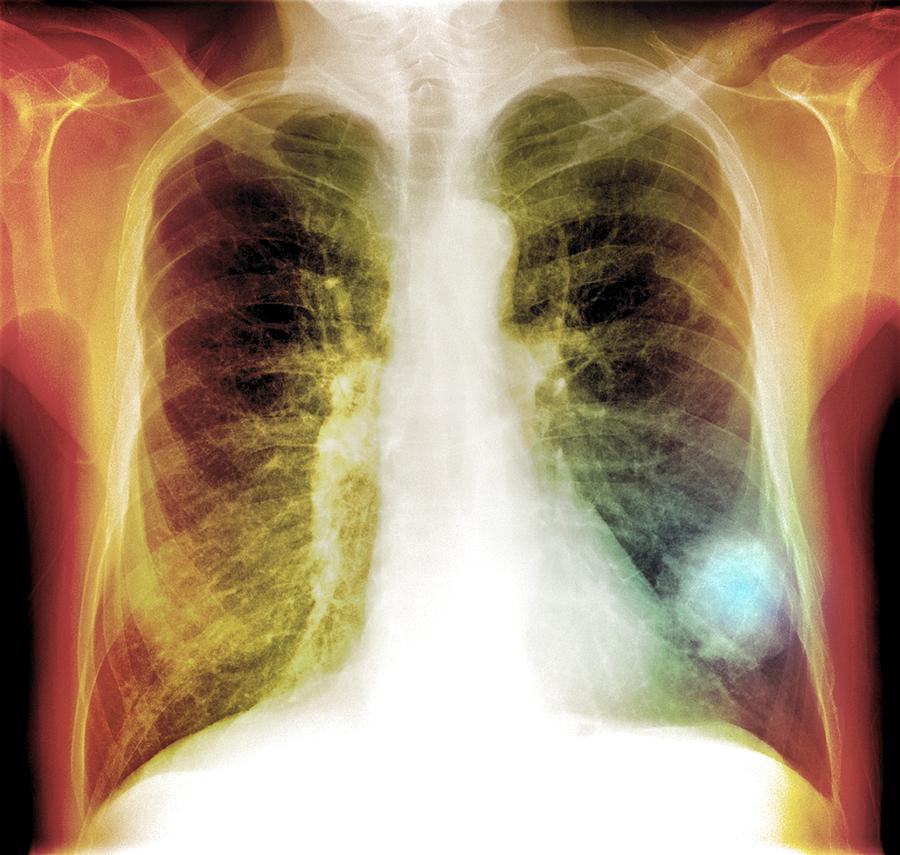 Lung Cancer, X-ray Photograph By Du Cane Medical Imaging Ltd | Fine Art ...