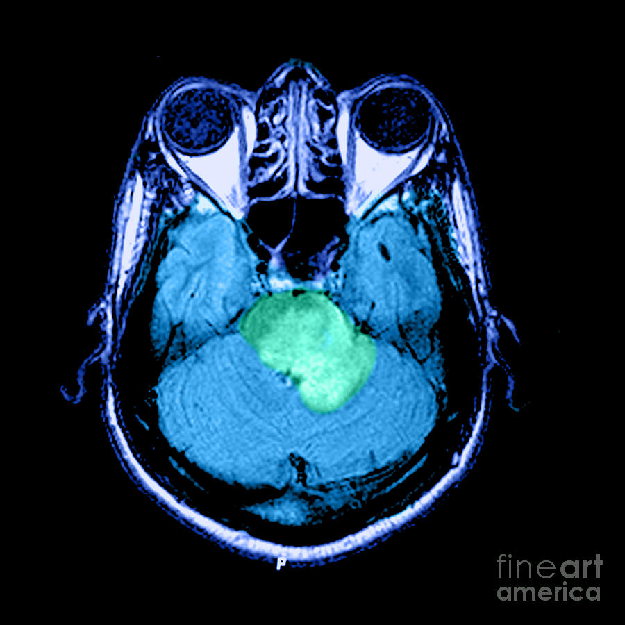 Mri Of Acute Ms #5 Photograph by Medical Body Scans