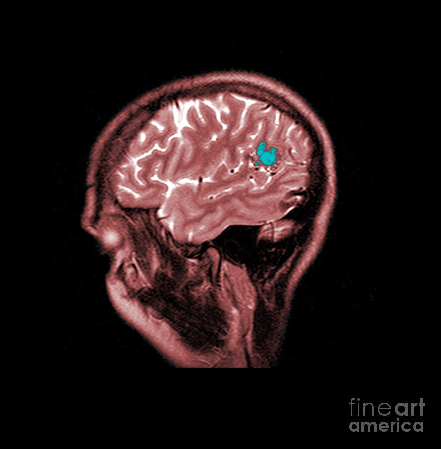 Mri Of Brain Avm #5 Photograph by Medical Body Scans