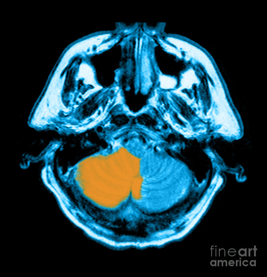 Mri Of Stroke Photograph by Medical Body Scans