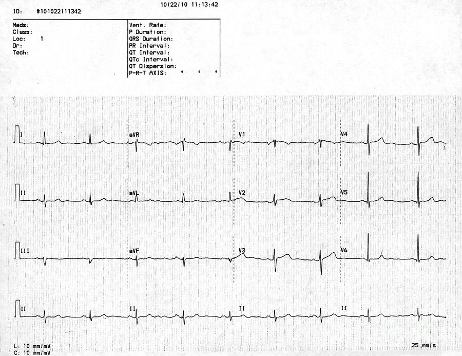Normal Ecg Photograph by Science Source Fine Art America
