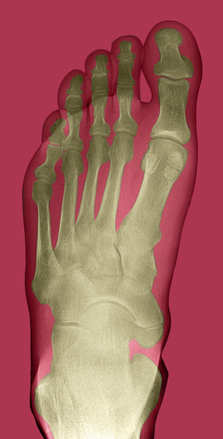 xray of normal foot