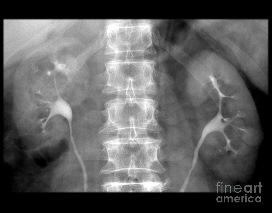 Normal Ivp #5 Photograph by Medical Body Scans
