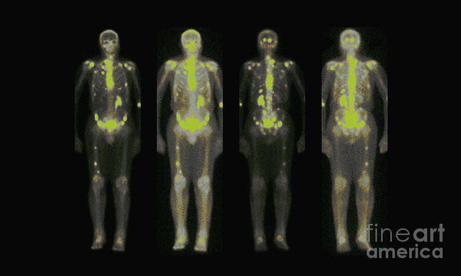 Nuclear Medicine Bone Scan #5 Photograph by Medical Body Scans