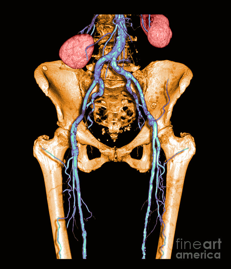 Pelvis And Upper Legs #5 Photograph by Medical Body Scans