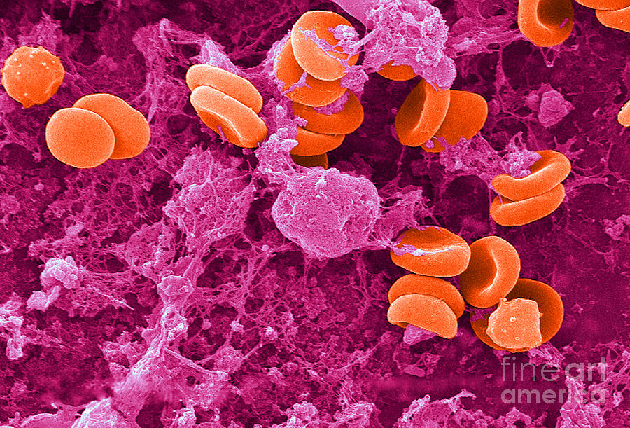 Red Blood Cells, Rouleaux Formation, Sem #5 Photograph by Science Source