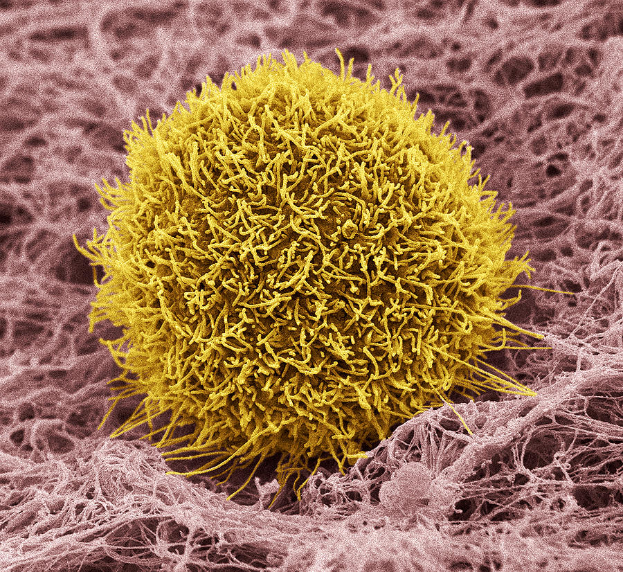 Squamous Cell Carcinoma Photograph - Skin Cancer Cell, Sem #5 by Steve Gschmeissner