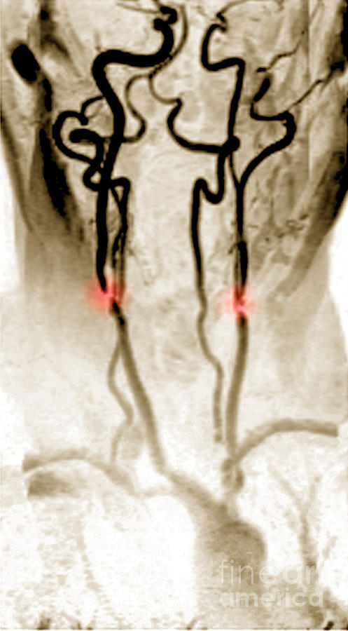 Stenosis Of The Internal Carotid #5 Photograph by Medical Body Scans