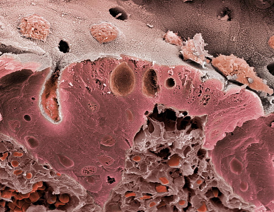 Medicine Photograph - Ulcerative Colitis, Sem #5 by Steve Gschmeissner