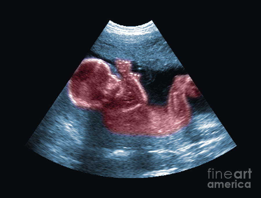 Ultrasound Of Fetus Photograph by Medical Body Scans - Fine Art America