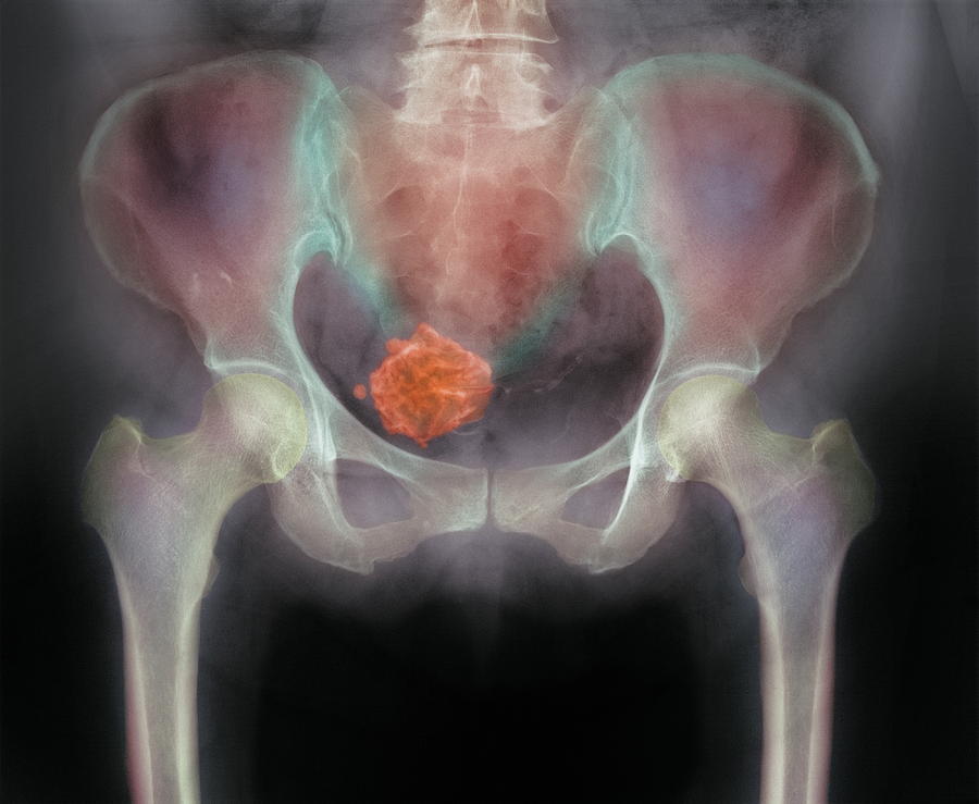 X-ray Photograph - Uterine Fibroid #5 by 