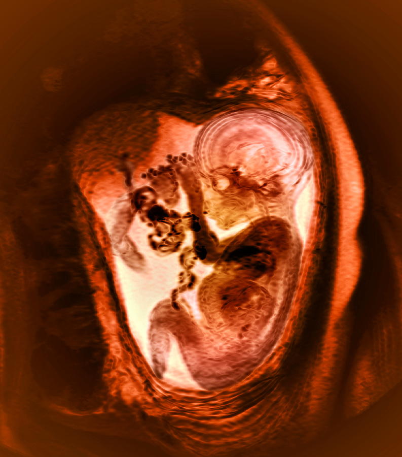 9 Month Foetus, Mri Scan Photograph by Du Cane Medical Imaging Ltd ...