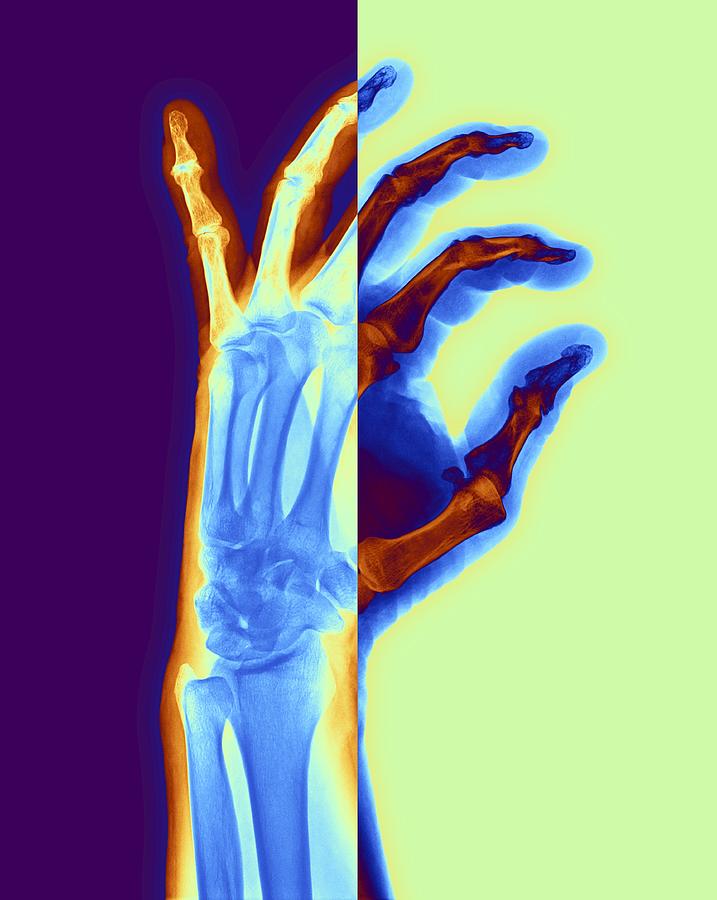 Arthritic Hand, X-ray #6 Digital Art by Pasieka