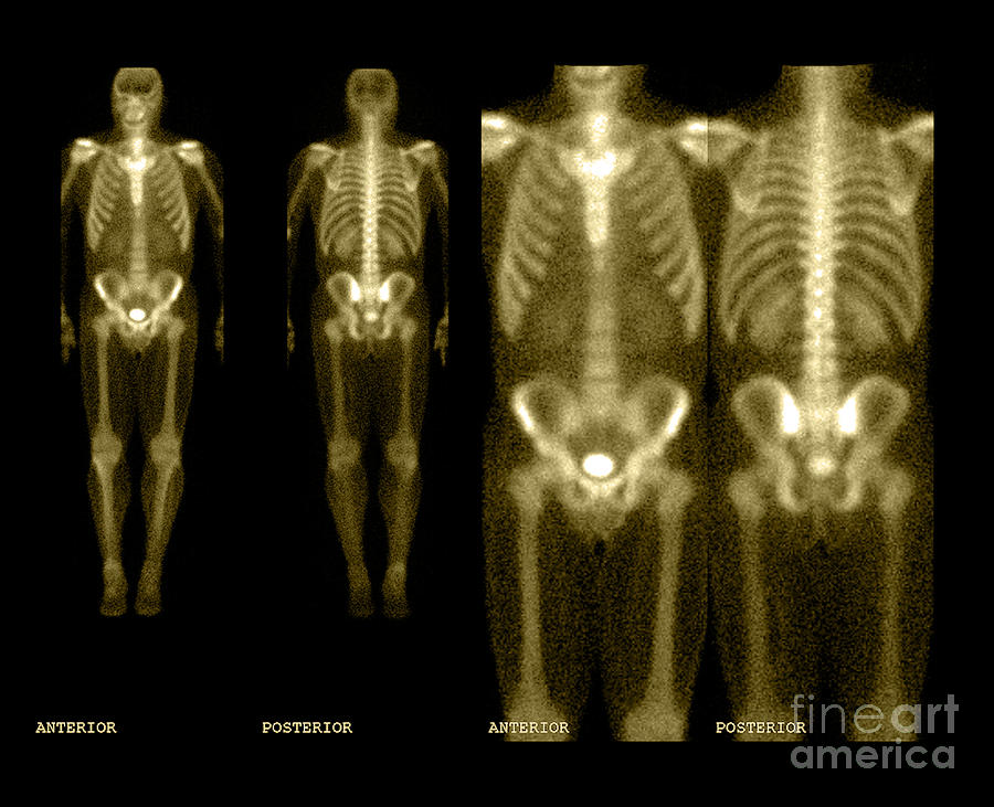 Bone Scan #6 Photograph by Medical Body Scans