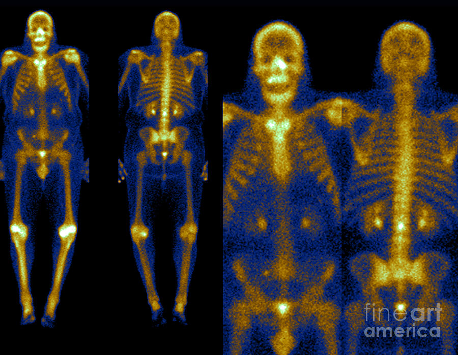 Bone Scans #6 Photograph by Medical Body Scans