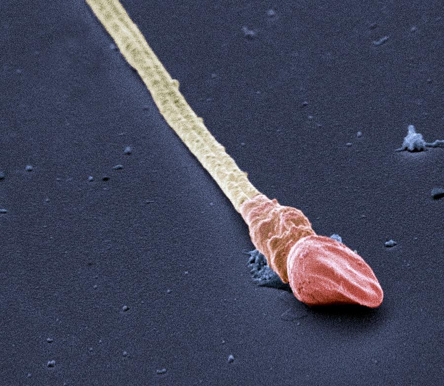 Deformed Sperm Cell Sem Photograph By Steve Gschmeissner 