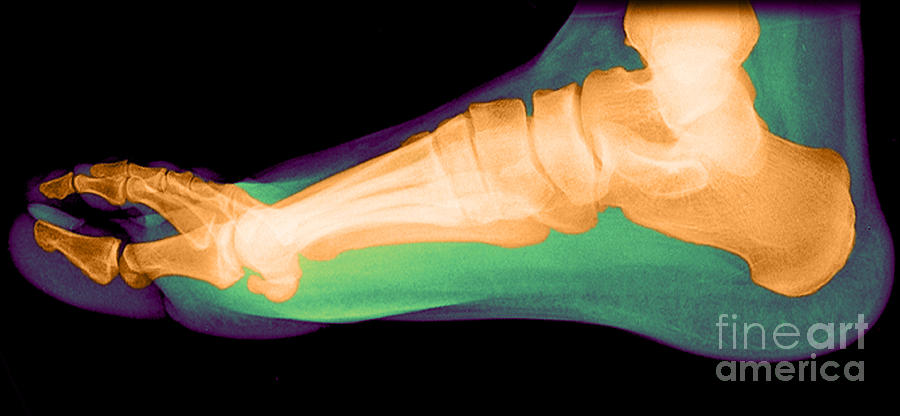 Flat Foot #6 Photograph by Medical Body Scans