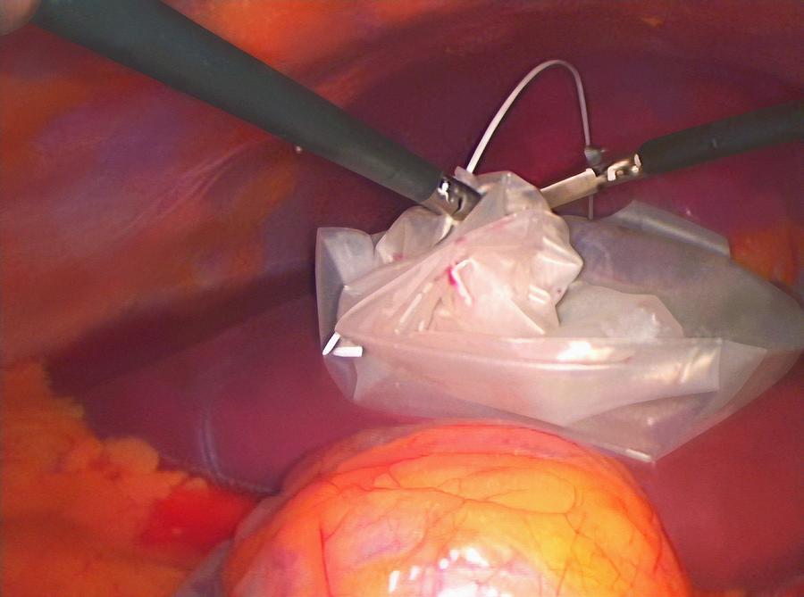 Tool Photograph - Gallbladder Removal Surgery #6 by Miriam Maslo